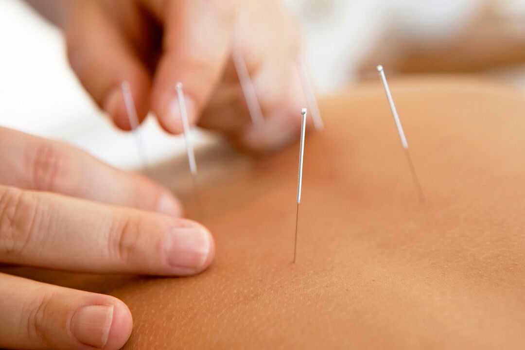 akupunktur för att öka styrkan