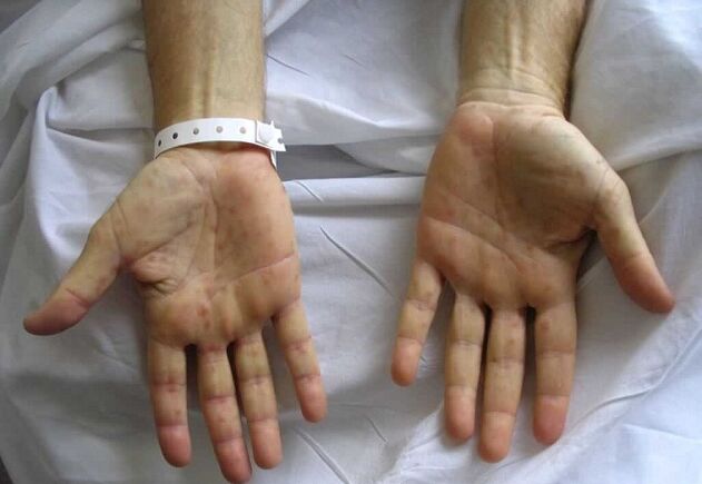 syfilis på händerna som en orsak till patologisk flytning från penis